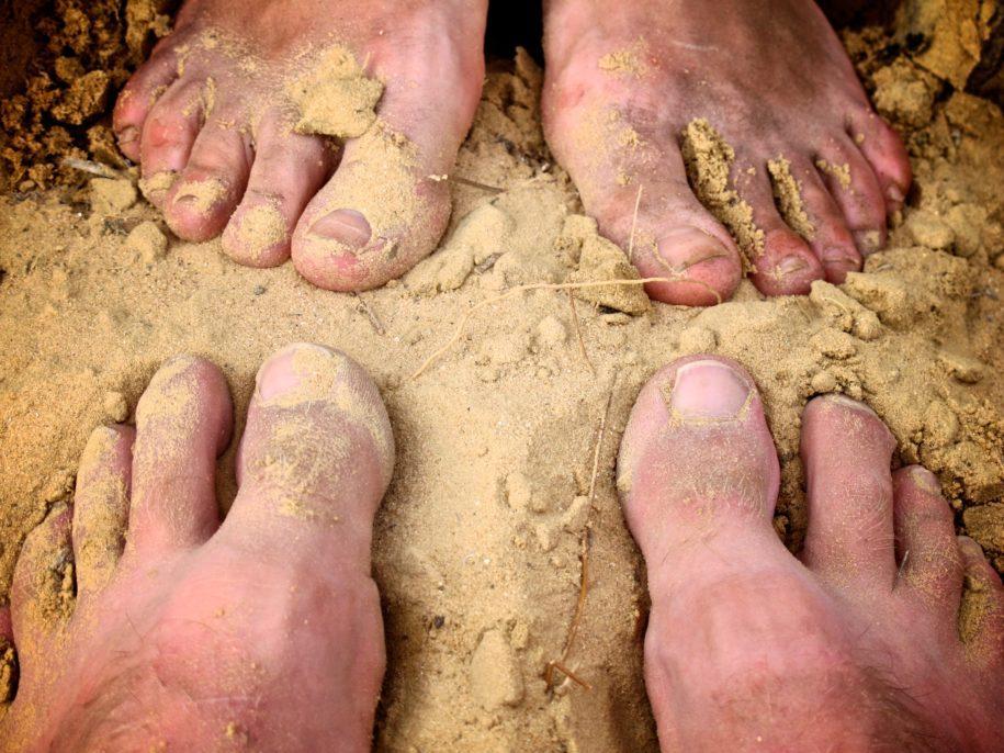 פטרת הציפורניים טיפול טבעי